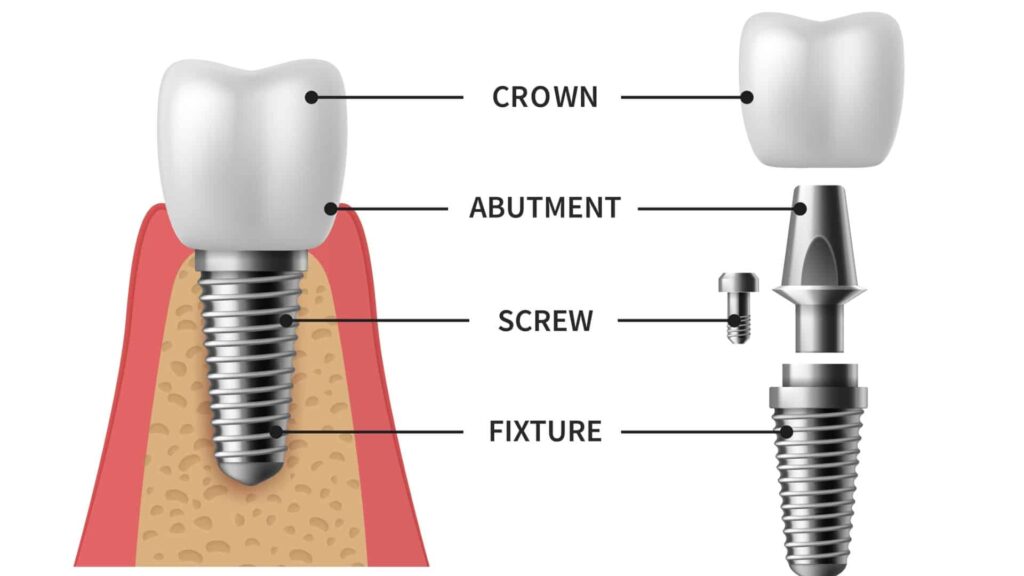 dental implants