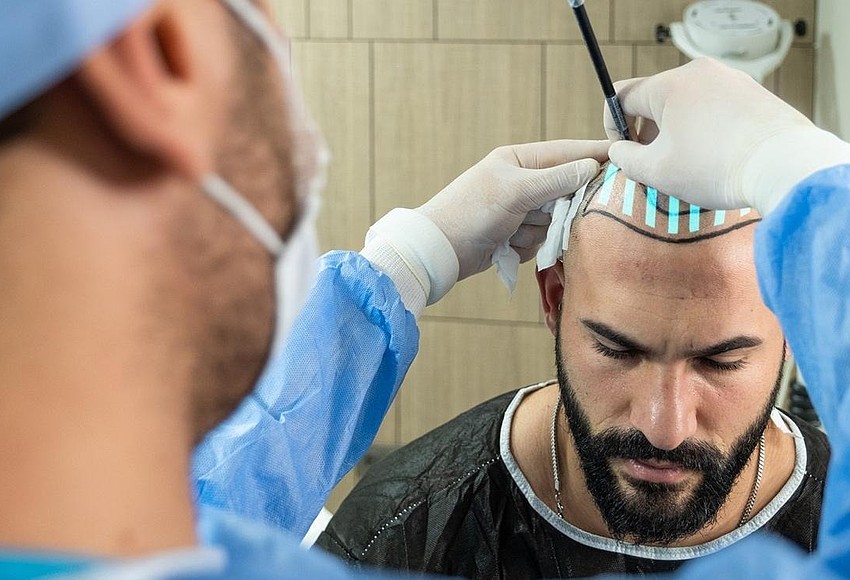 Hair Transplant
